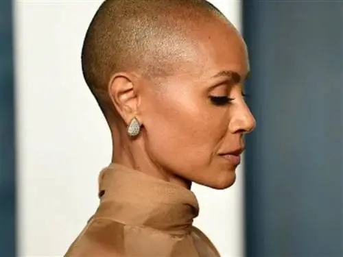 Не только Джада Пинкетт-Смит, тысячи людей страдают алопецией. Поможет ли им лекарство от артрита?