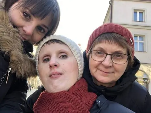 Я живу с фибродисплазией. Джоанна: Мое тело становится живой статуей
