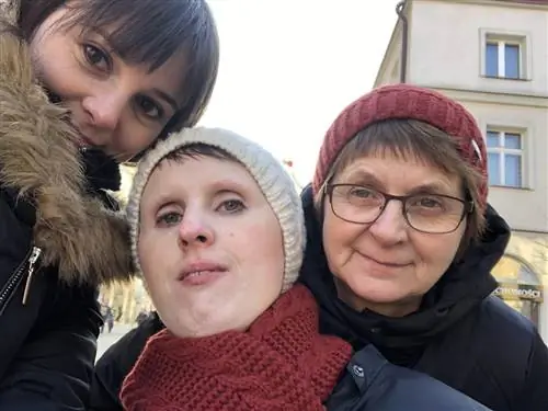 Я живу с фибродисплазией. «Мое тело становится живой статуей»