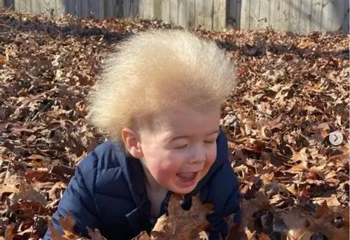 Мальчик со «стеклянными волосами» стал звездой Instagram. Это редкое генетическое заболевание