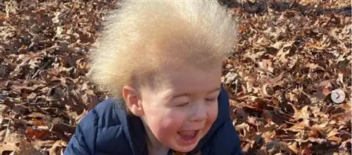 Мальчик со «стеклянными волосами» стал звездой Instagram. Это редкое генетическое заболевание