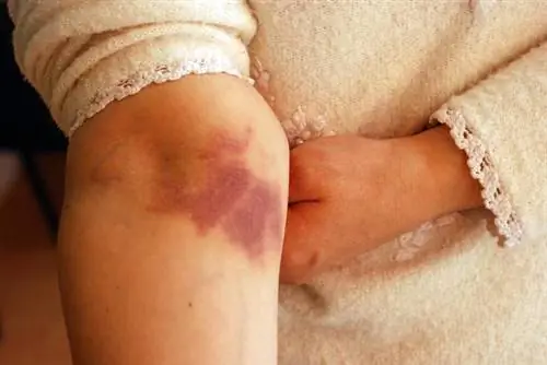 Уход за шрамами от ожогов. Методы лечения шрамов от ожогов