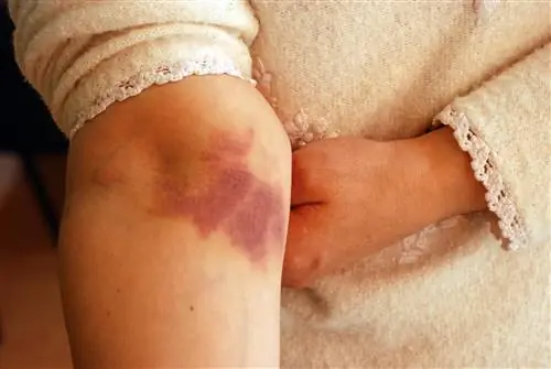 Уход за шрамами от ожогов. Методы лечения шрамов от ожогов