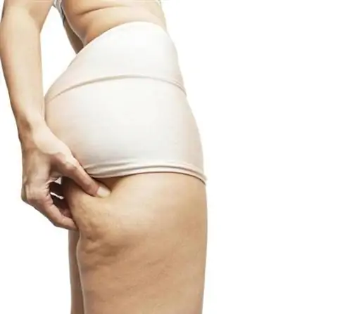 Целлюлит - откуда он берется? Как определить степени целлюлита?