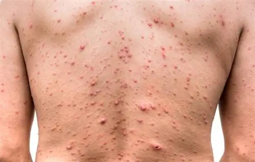 сыпь от оспы