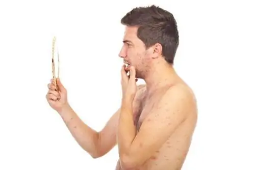 Ветрянка у взрослых: симптомы, лечение, осложнения ветрянки у взрослых