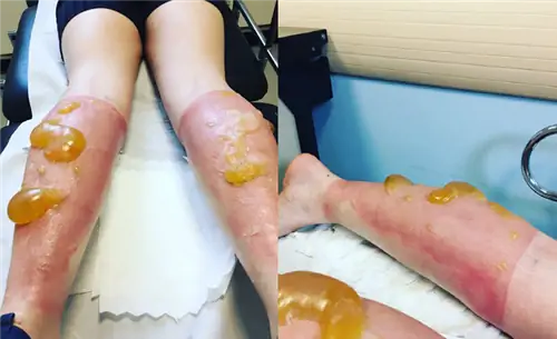 солнечный ожог Джули