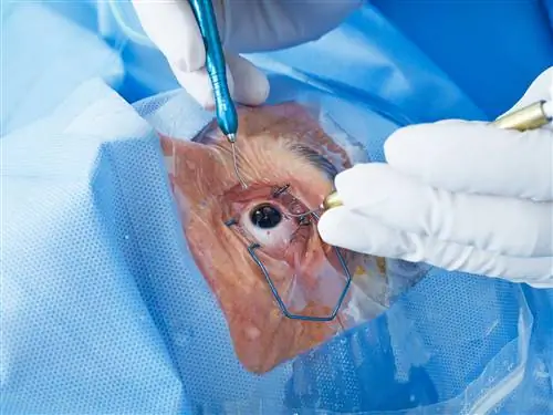 Катаракта: симптомы. Методы удаления катаракты