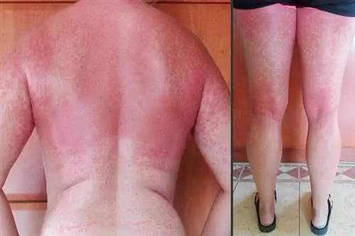 аллергия на солнце после антибиотиков