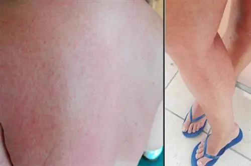 аллергия на солнце после антибиотиков