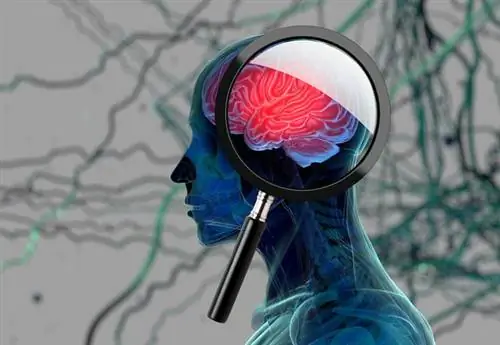 Нарушения мозгового кровообращения