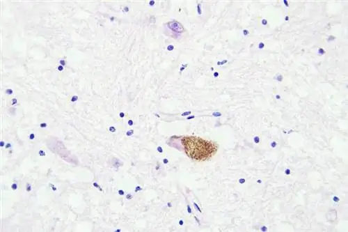 Глиобластома головного мозга