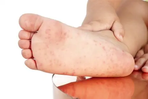 Бостонская болезнь: симптомы. Это ветряная оспа или бостон?