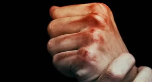 ушибленные суставы