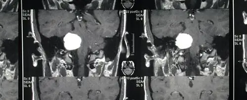 Опухоль головного мозга.