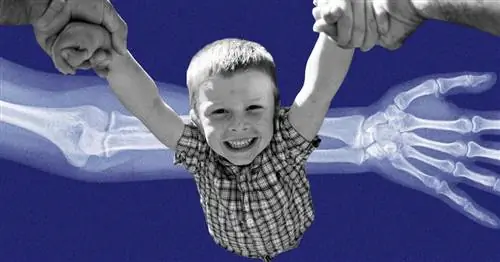 Ваш ребенок вывихнет локоть. Вот как это исправить