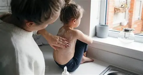 Может ли ветряная оспа убить вас? Ответ пугает