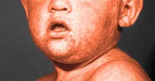 Как распознать и лечить симптомы кори