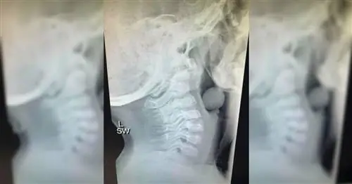 Почему этот рентгеновский снимок виноградины, застрявшей в горле ребенка, стал вирусным