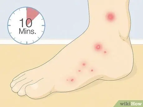 Вылечить укус огненного муравья Шаг 5