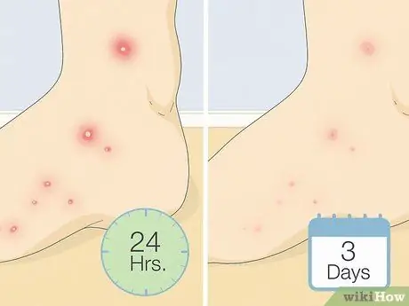 Лечить укус огненного муравья Шаг 6