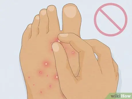 Лечить укус огненного муравья Шаг 7