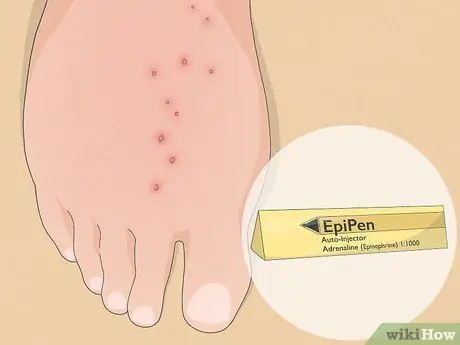 Лечить укус огненного муравья Шаг 9