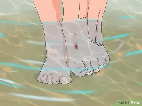 Лечить укус ската Шаг 5