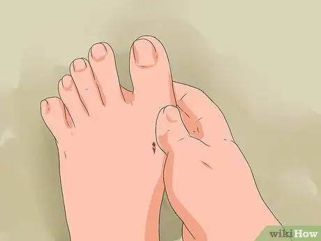 Лечить укус ската Шаг 6