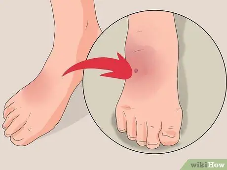 Лечить укус ската Шаг 8