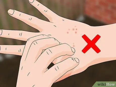 Лечить укусы дубового клеща Шаг 1