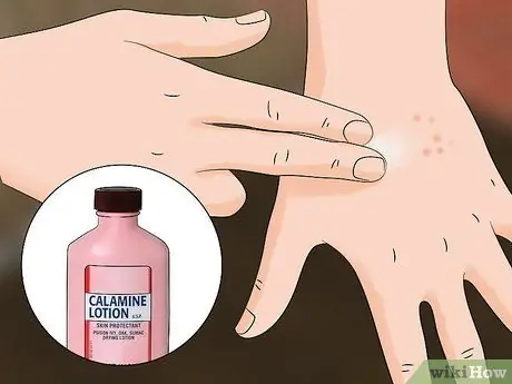 Лечить укусы дубового клеща Шаг 2