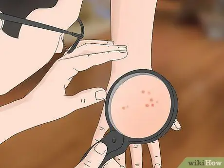 Лечить укусы дубового клеща Шаг 6