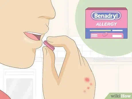 Лечить укусы клопов Шаг 10