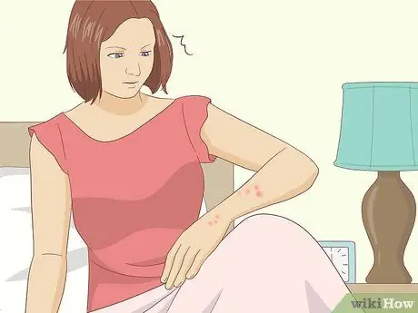 Лечить укусы клопов, шаг 2