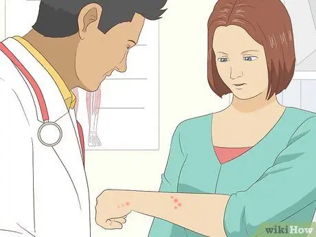 Лечить укусы клопов, шаг 4