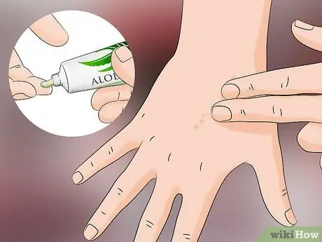 Лечить укусы песчаных блох Шаг 6