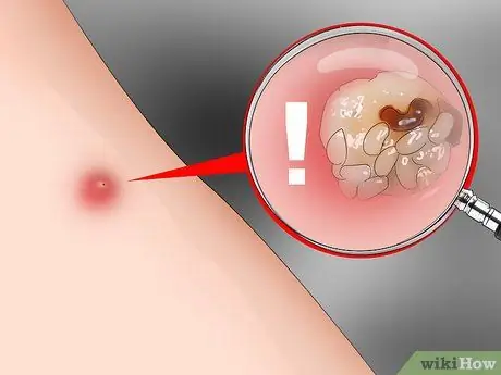 Лечить укусы песчаных блох Шаг 8