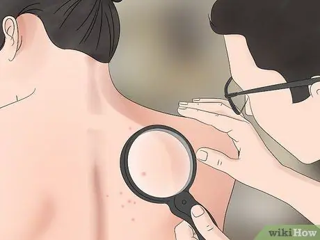 Лечить укусы песчаных блох Шаг 9