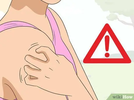 Лечить укусы чиггера, шаг 14