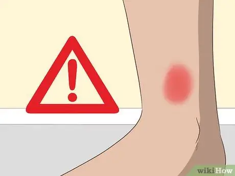 Лечить укусы чиггера, шаг 15