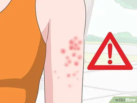 Лечить укусы чиггера, шаг 16