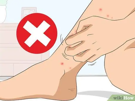 Лечить укусы чиггера Шаг 9