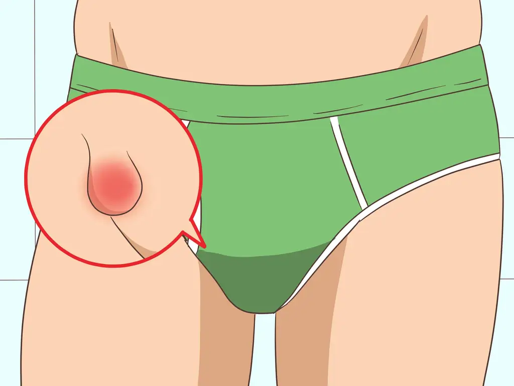 3 способа избавиться от укусов чиггеров