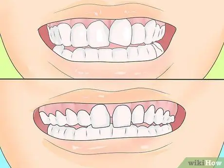 Уговорите родителей позволить вам поставить брекеты Шаг 1