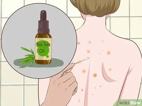 Быстрое избавление от прыщей на спине, шаг 7