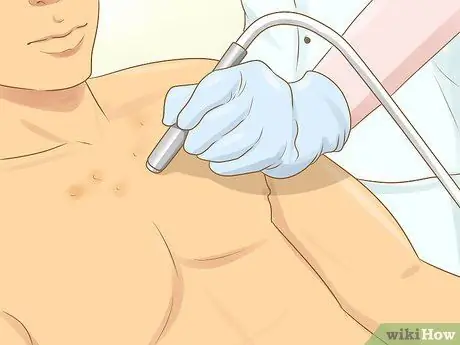 Избавьтесь от шрамов от прыщей на груди Шаг 3