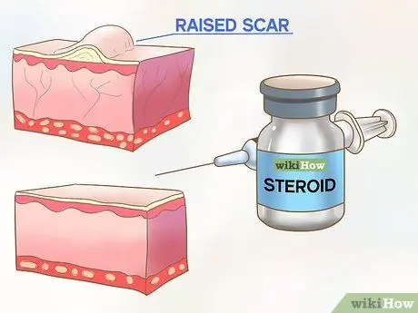 Избавьтесь от шрамов от прыщей на груди Шаг 4