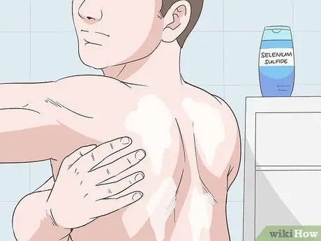 Лечить грибковые прыщи на спине Шаг 1