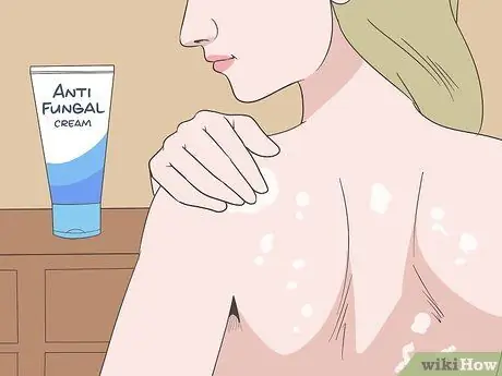 Лечить грибковые прыщи на спине Шаг 12